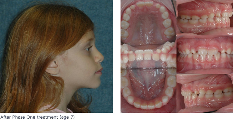 After Phase one treatment (age 7)