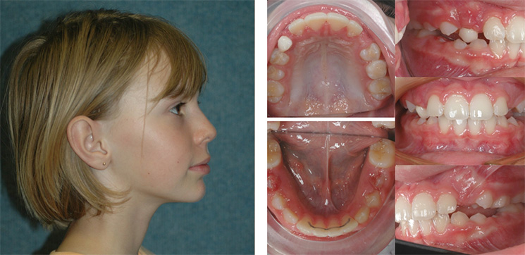 Open Bite Malocclusion After