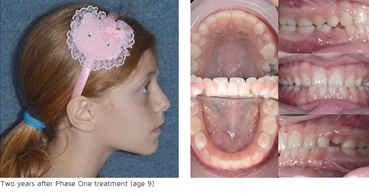 Two years after phase 1 treatment (age 9)