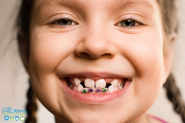 How Early Should Childrens Braces Be Put On The Teeth