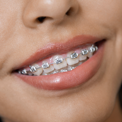 https://sandiegokidsdentist.com/wp-content/uploads/2019/02/traditional-braces.png