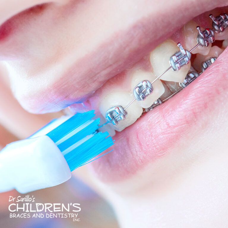 Keep Good Oral Hygiene With Braces | Children's Braces and Dentistry